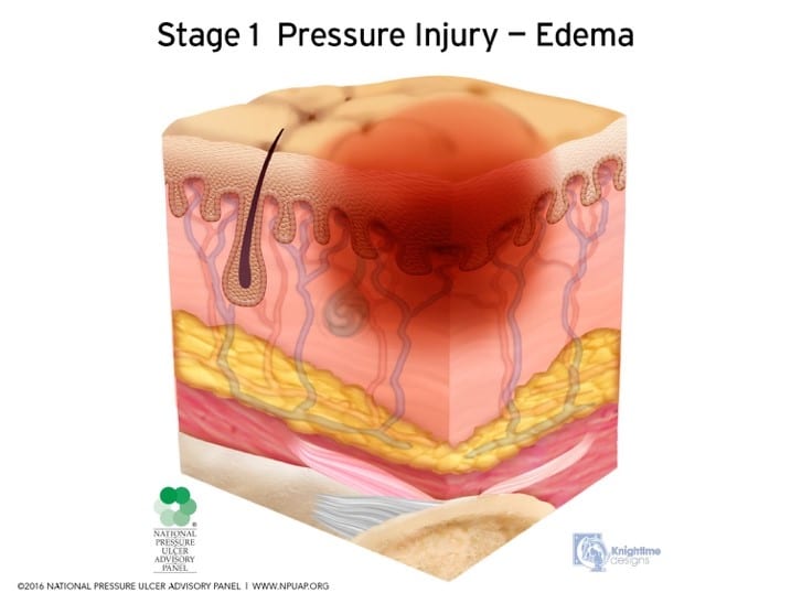 sacral area edema